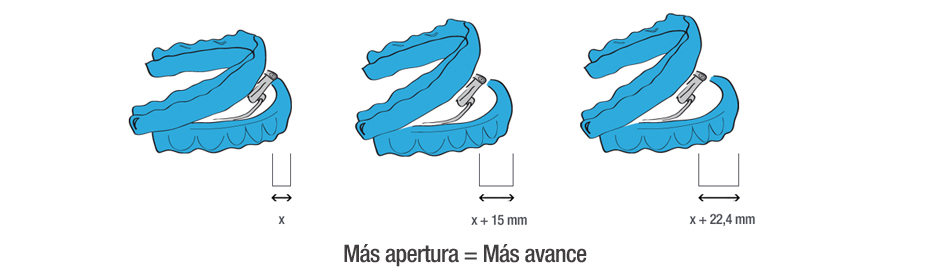 Férula de avance mandibular - Centre Odontològic els Quinze