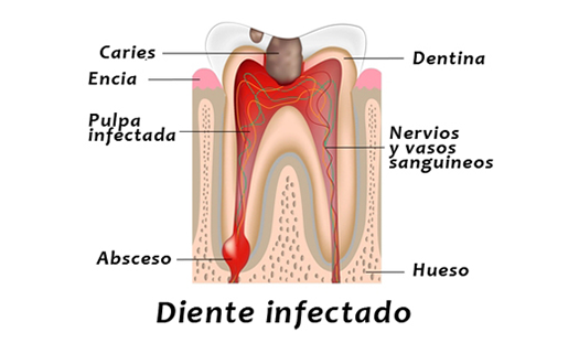 endodoncia