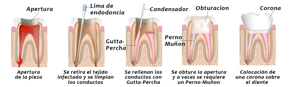 endondocia2